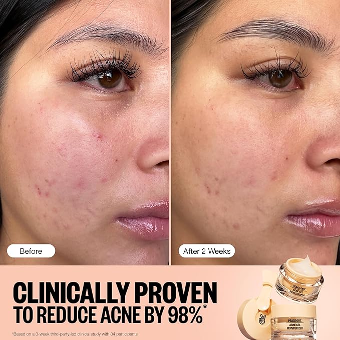 PEACE OUT Skincare Acne Gel Moisturizer, For Daily Facial Use with Salicylic Acid & Niacinamide, Boost Hydration and Help Prevent Acne & Blackheads, for Men & Women, 1.69 fl oz