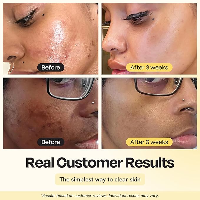 Gleamin Vitamin C Clay Mask for Dark Spots, Turmeric Clay Face Mask Skin Care, Deeply Cleanses & Refines Pores, Brightens Uneven Tone and Helps Improve Post-Blemish Scarring & Texture, Up to 20 Uses