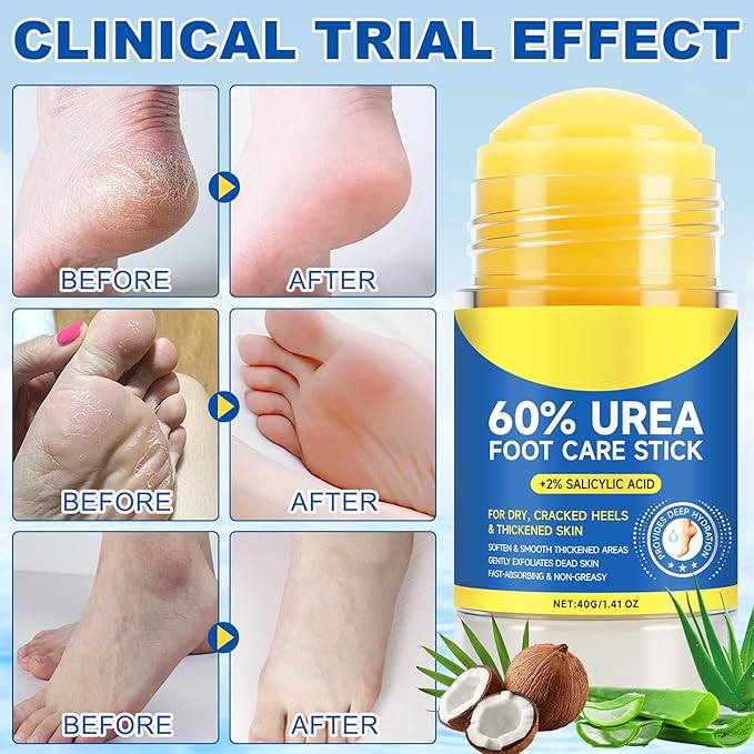 Urea Cream 60% Plus Salicylic Acid 2% Foot Balm Stick for Dry Cracked/Chapped Heel, Skinned knees, Hand Intensively Hydration & Moisturization, Callus Removal & Softening, Soothing|1.41 Oz/40 G