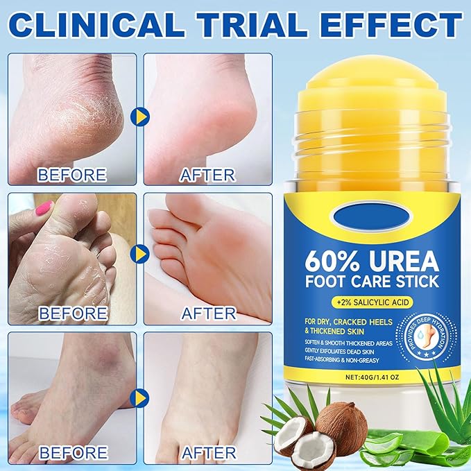 60% Urea Foot Cream Stick with 2% Salicylic Acid, Extra-Strength Cracked Heel Repair for Dry Feet & Calluses, Moisturizing Urea Cream Stick for Dead Skin Removal, Heel Balm for Rough Skin(2pcs)