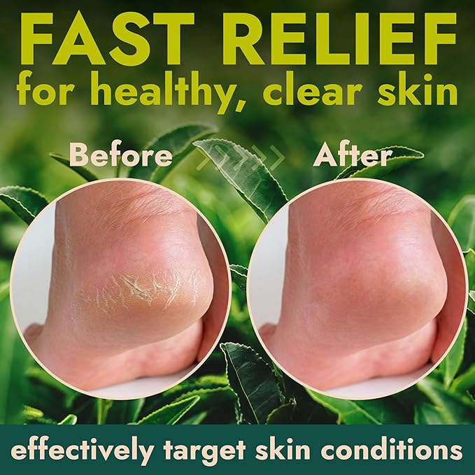 Foot Callus Remover Gel | Extra Strength Callus Remover for Feet with Tea Tree Oil | Professional-Grade Pedicure Treatment | 50 Applications per Bottle, Includes 3 Pumice Stones | 14 fl oz