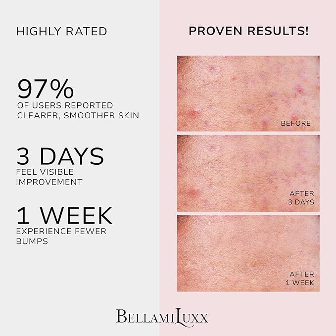 Butt Acne Treatment Set: Acne Soap Bar + Butt Treatment Lotion for Breakouts on Buttocks, Thighs, Back, Chest & Ingrown-Prone & Folliculitis-Prone Skin – Helps Reduce Body Breakouts