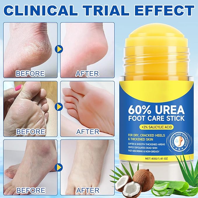 60% Urea with 2% Salicylic Acid Urea Foot Care Stick, Cracked Heel Repair & Deep Moisturizing Treatment for Dry, Rough, Balm for Heels, Elbows, Knees & Hands, Exfoliating Dead Skin, Softening Skin