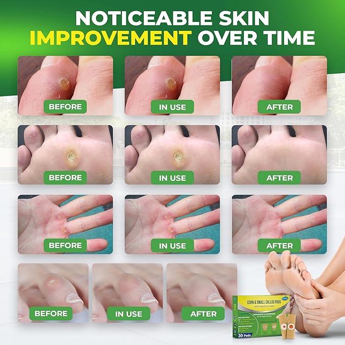 Corn Remover Pads for Feet Toes: 2 Boxes of 30 Pack Salicylic Acid Extra Strength Treatment - Fast Effective Medicated Bandages for Kids Adults Seniors Teens Runners Hikers Workers Men Women 02