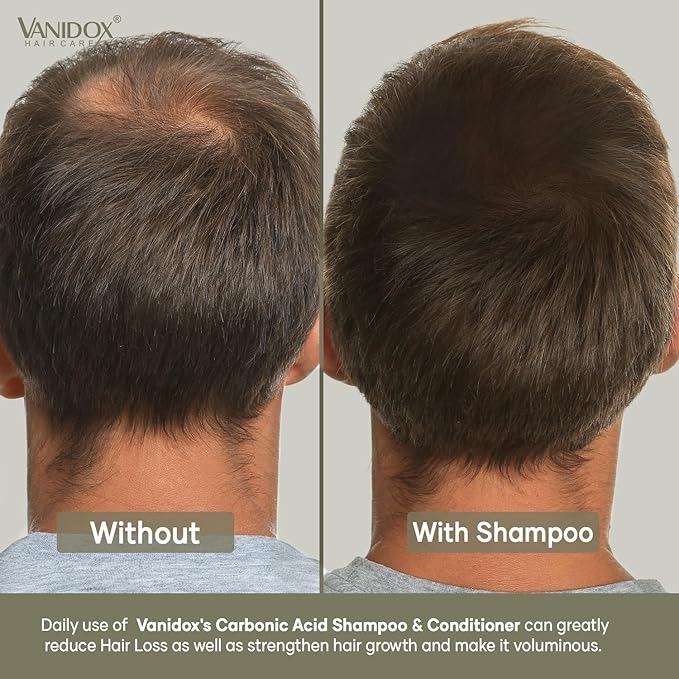 Carbonic Acid Shampoo for Men and Women with DHT Blockers - Made in USA - Stimulates Hair Growth, Scalp Exfoliator, Sulfate Free Shampoo with Biotin and Tea Tree Oil (16 Fl Oz)