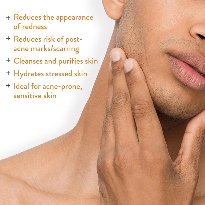 AcneFree Hypochlorous Acid Soothing Spray for Face & Body – Redness Relief Mist for Acne-Prone, Sensitive, or Irritated Skin – Gentle Daily Spray for Breakout Support & Skin Barrier Balance – 4 ounce