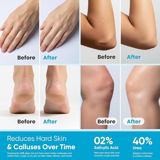 Urea Cream 40% for Feet and Hands |Intensive Moisturizer for Dry, Cracked Skin, Heels, and Calluses | Hydrating Foot Cream for Rough, Thick Skin (3.38 oz / 100g)