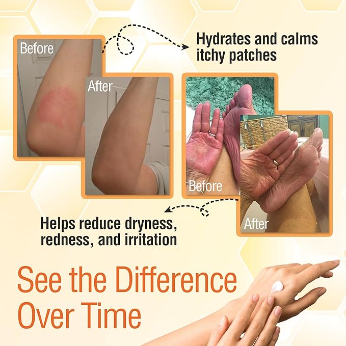 Wild Naturals Manuka Honey Moisturizer for Dry, Sensitive Skin – Eczema Relief Face Cream – Soothing Cream for Redness & Irritation – Face, Hand & Body Moisturizer for Women & Men